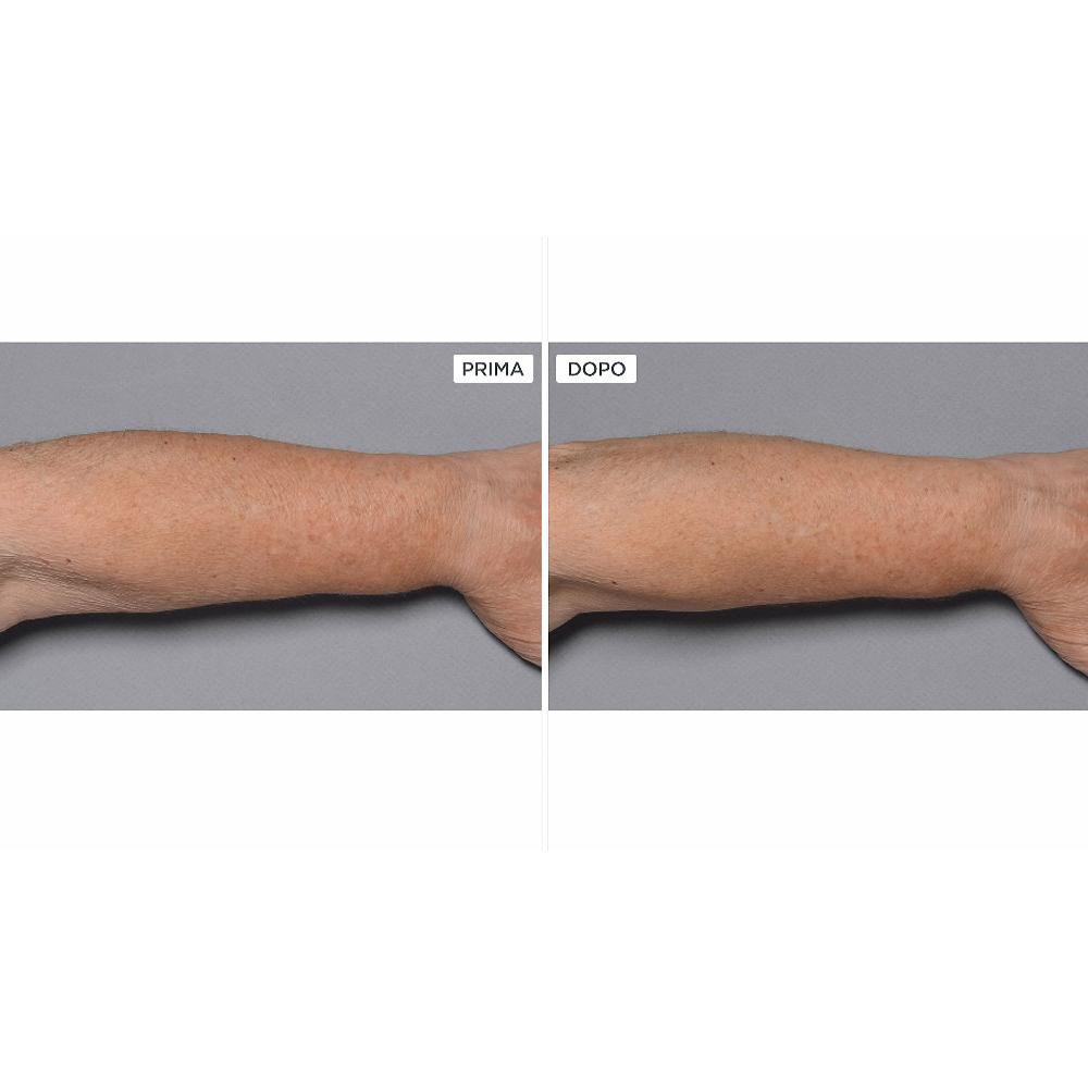 QVC Perricone MD Cold Plasma+Fragile Skin corpo 2pz Offerta natalizia
