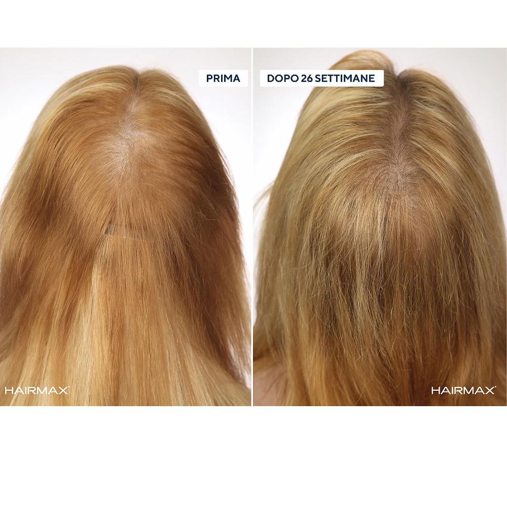 QVC HairMax LaserBand Dispositivo laser crescita capellI Offerta speciale