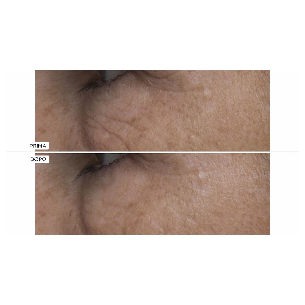 QVC Perricone MD Hypoallergenic e Cold Plasma+ Kit viso occhi labbra Black Friday Prezzi